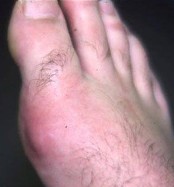 A common appearance of Gout - Redness and swelling around the 1st metatarsophalangeal joint of the big toe